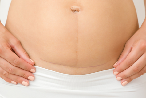 Why C-section scar massage is important? - Woodside Clinic